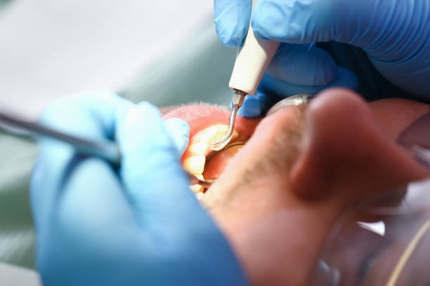 Best Emergency Root Canal Treatment in Dane, WI